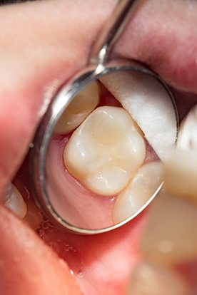 a dental mirror showing a tooth