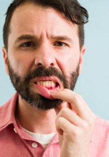 Man pulling down lower lip to reveal red spot in gums