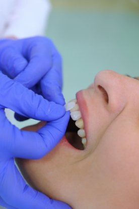 Woman receiving dental bonding from her cosmetic dentist