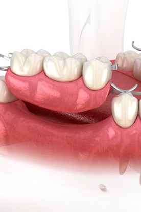Illustration of partial dentures