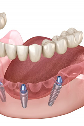 Exploded illustration of implant dentures
