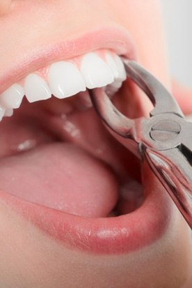 Close up of a person having their tooth pulled by a dentist