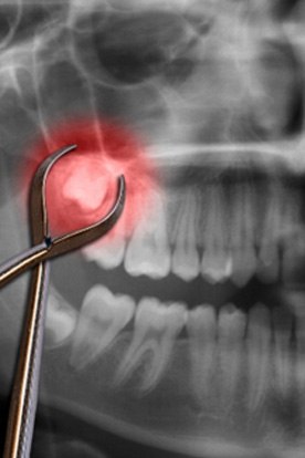 Dental tool laid over an X ray showing an impacted wisdom tooth highlighted red