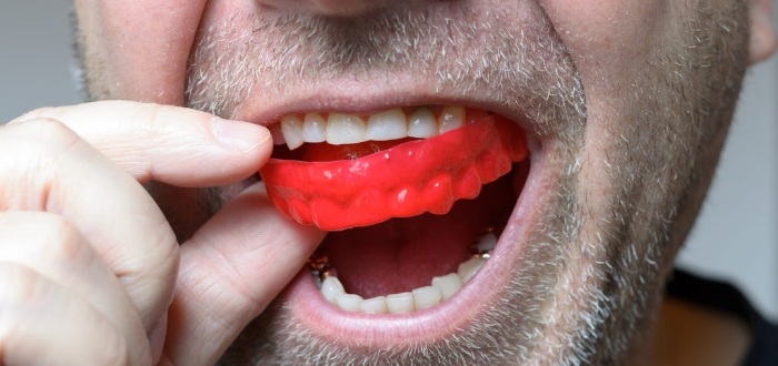 Closeup of person placing an athletic mouthguard
