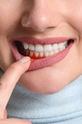 Close up of person pointing to red area of their gums