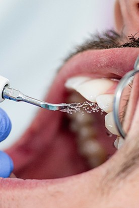 a person having their teeth cleaned by a dentist