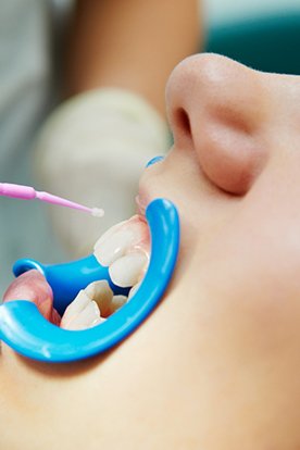 a dentist applying dental sealants to a child’s teeth
