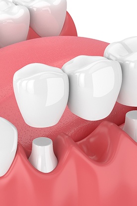 Illustration of dental bridge being placed on molars