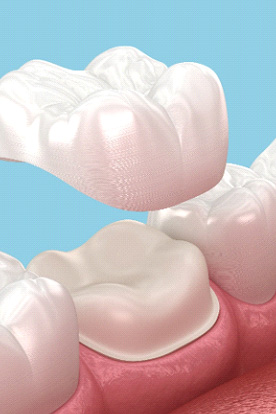 A digital image of a same-day dental crown
