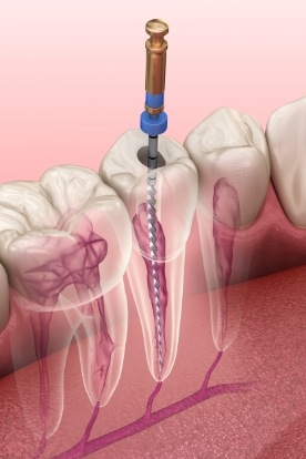 Illustrated dental instrument cleaning the inside of a tooth during root canal treatment